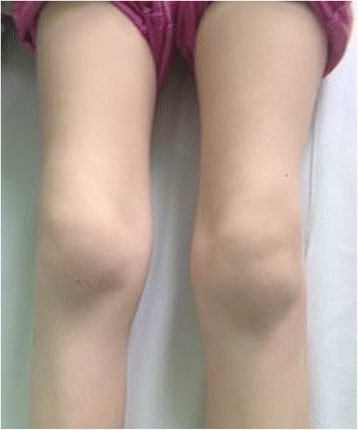 Bilateral knee arthritis
