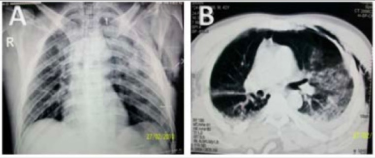 Bilateral lung contusions