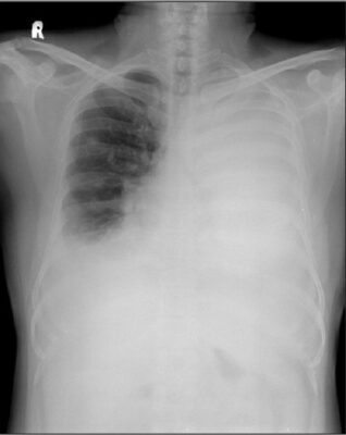 Imaging of the Lungs and Pleura | Concise Medical Knowledge