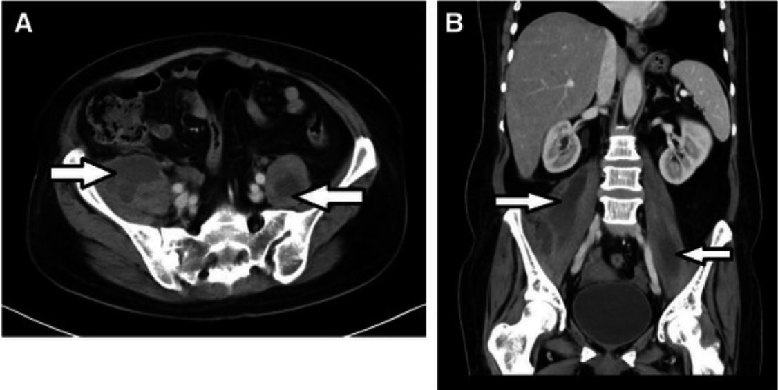 Bilateral primary psoas abscesses due to methicillin-resistant staphylococcus aureus in a neutropenic patient