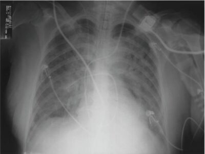 Bilateral pulmonary parenchymal infiltrate compatible with ards
