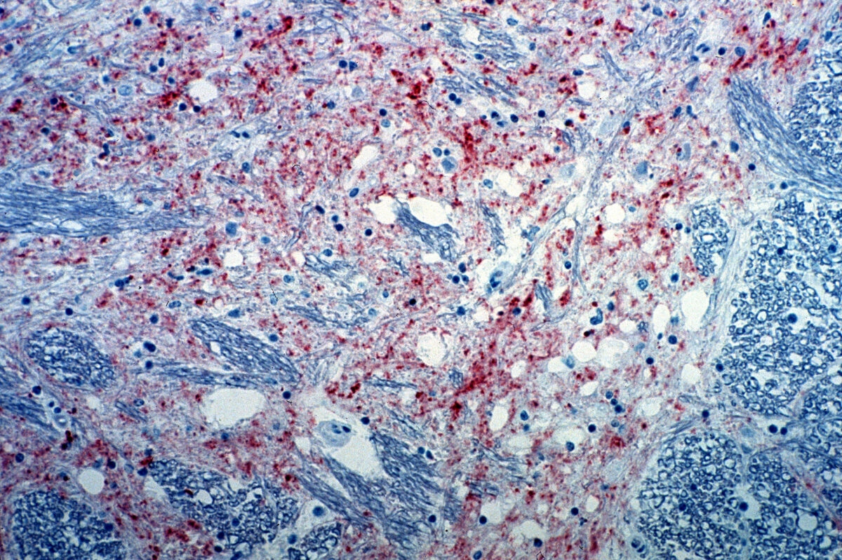 Biopsy brain of a cow with bovine spongiform encephalopathy