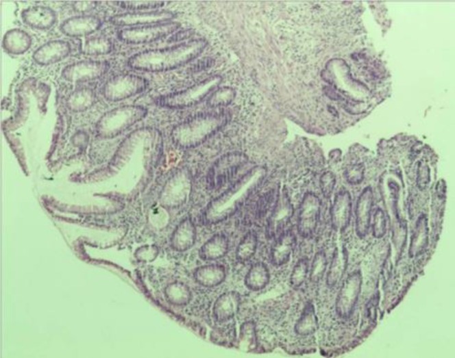 Biopsy revealed adenomatous polyp
