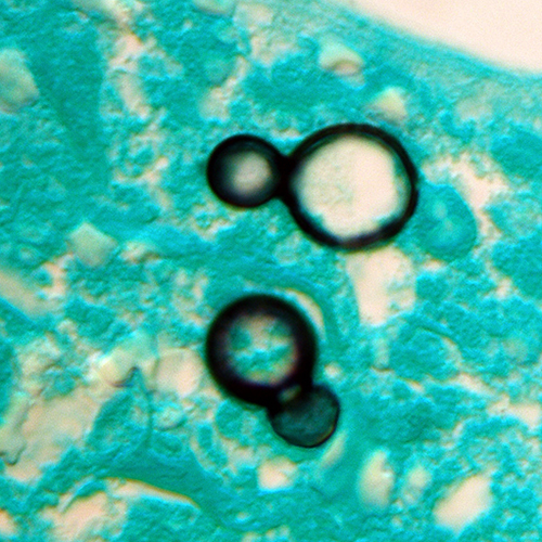 Blastomyces dermatitidis