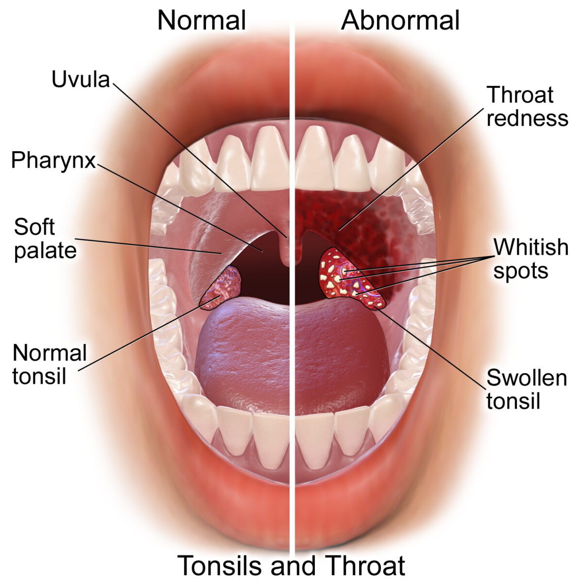Comparison normal oropharynx and acute tonsillitis