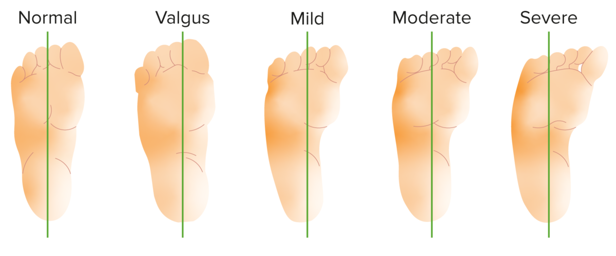 Bleck classification of metatarsus adductus