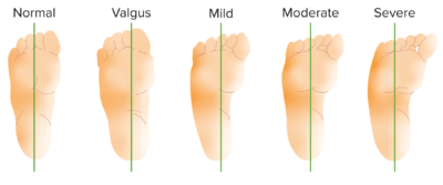 Foot Deformities | Concise Medical Knowledge