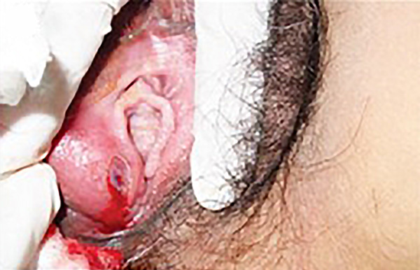 Bleeding bartholin gland cyst