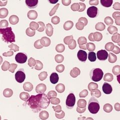 Blood smear from an adult with marked lymphocytosis