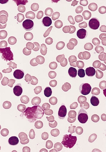 Esfregaço de sangue periférico de um adulto com linfocitose acentuada