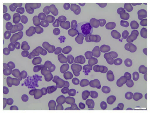 Blood smear pseudothrombocytopenia
