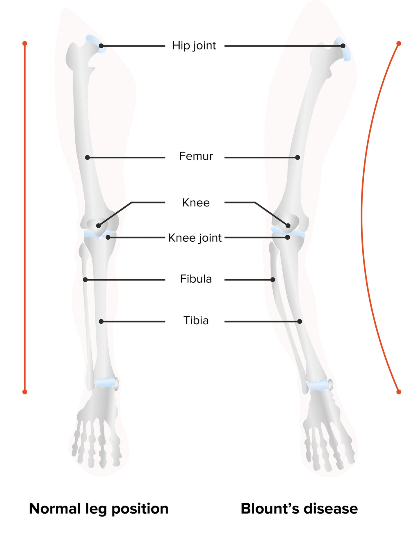 Blount's Disease | Concise Medical Knowledge