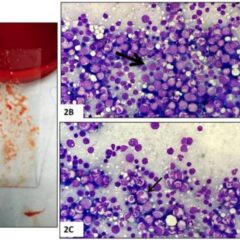 Bone marrow aspirate in megaloblastic anemia with cutaneous hyperpigmentation