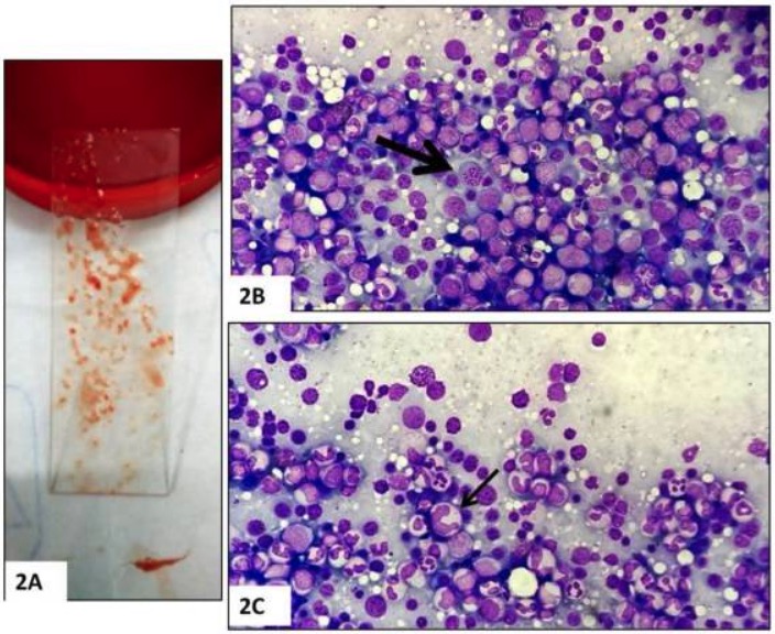 Bone marrow aspirate in megaloblastic anemia with cutaneous hyperpigmentation