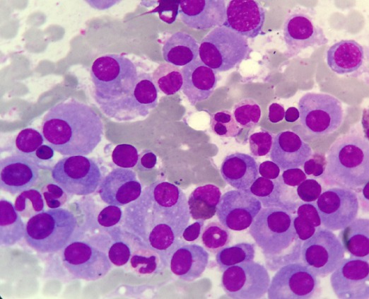 Bone marrow infiltration multiple myeloma