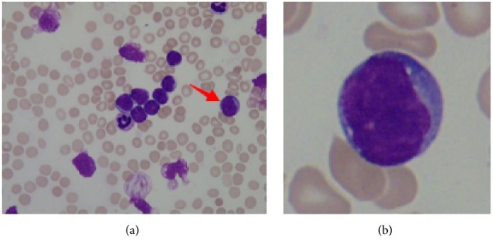 acute lymphoblastic leukemia patient