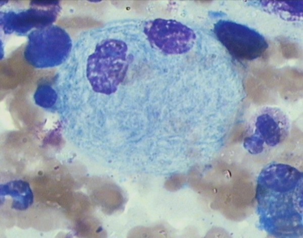 Bone marrow smear showing gaucher cell