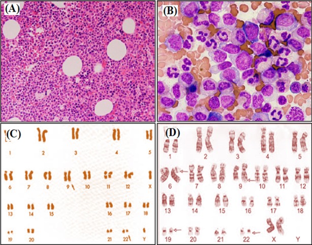 Bone marrow studies and karyotyping of cml