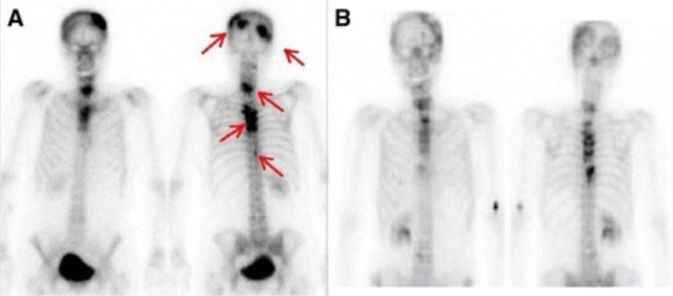 Bone scintigraphy during interferon-α treatment and after