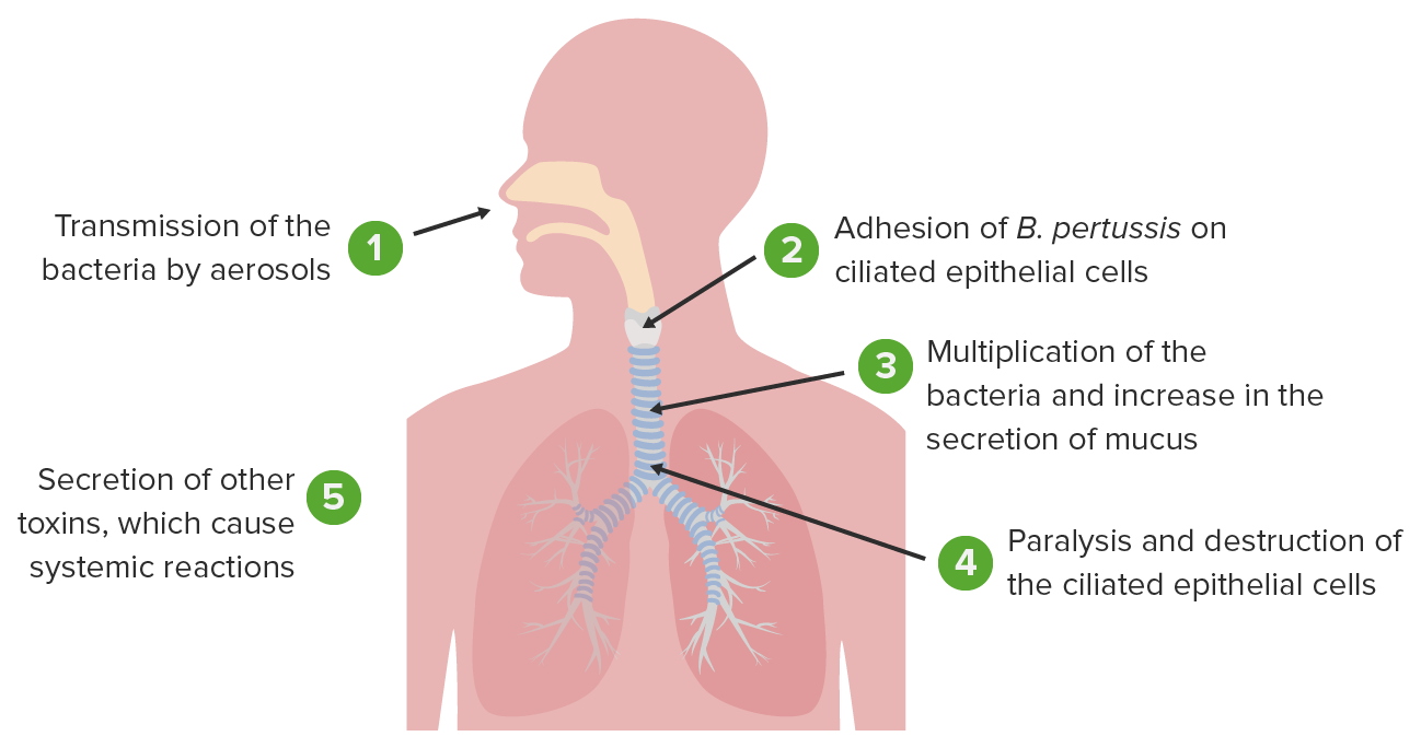 Tosse Convulsa Concise Medical Knowledge