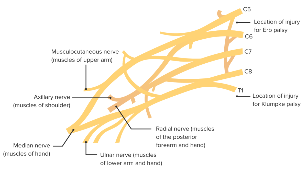 Brachial plexus injuries associated with shoulder dystocia