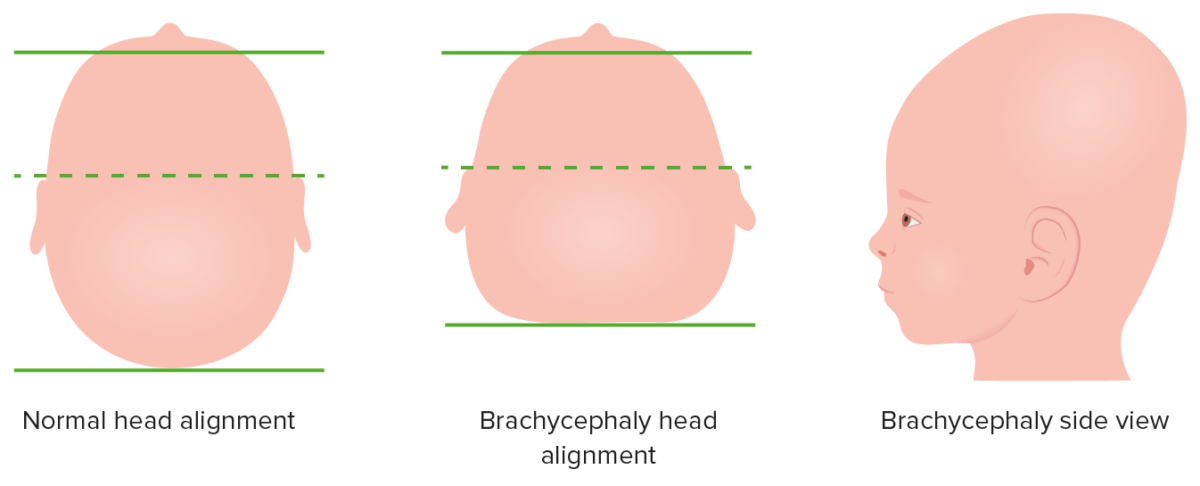 Brachycephaly diagram