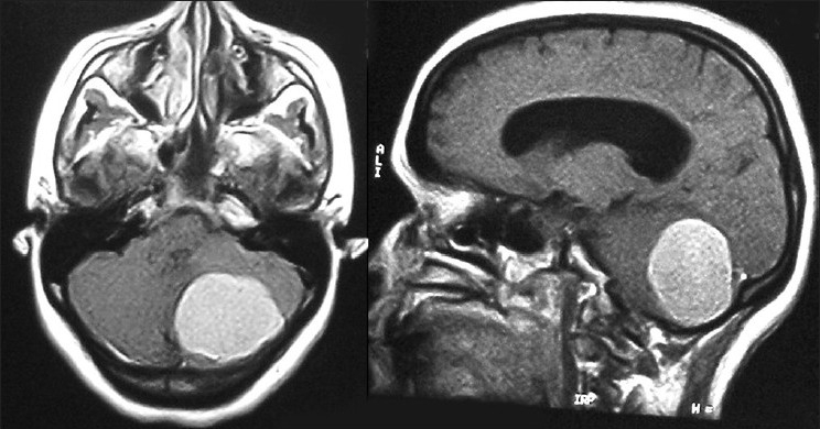 Hidrocefalia de ressonância magnética cerebral