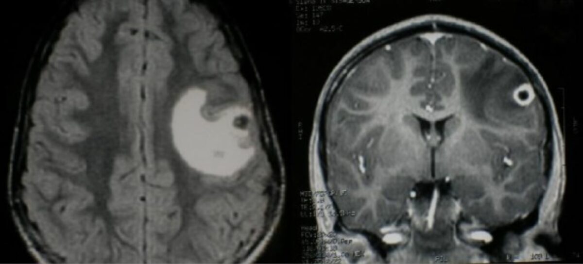 Brain mri in neurocysticercosis