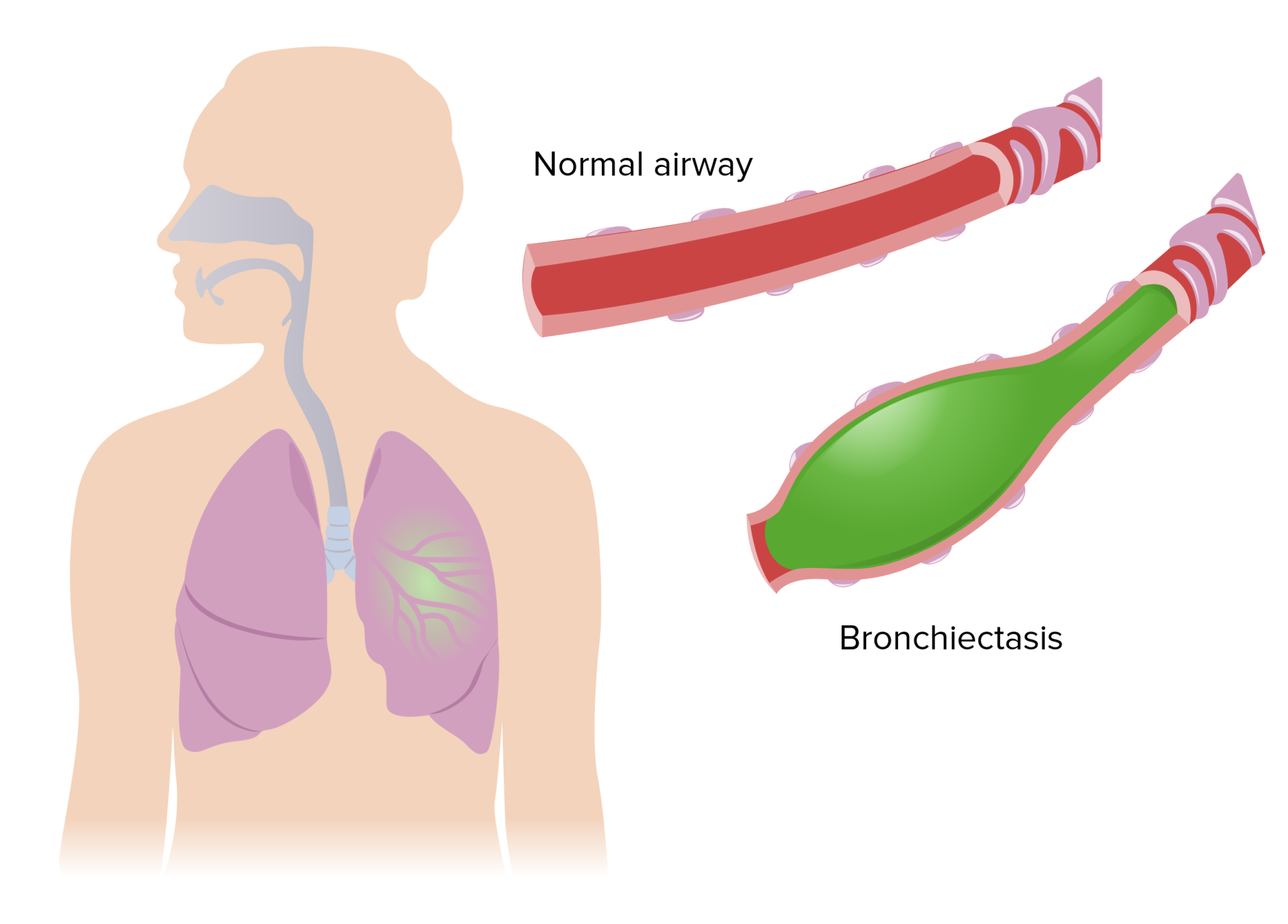 Bronchiectasis Concise Medical Knowledge