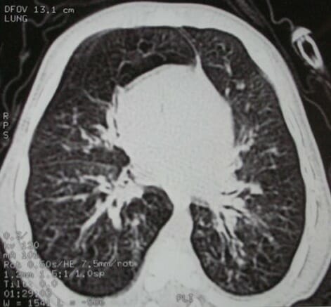 Bronchiectasis with peribronchial wall thickening