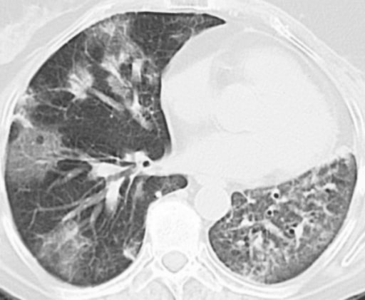 Bronchiolitis obliterans organizing pneumonia
