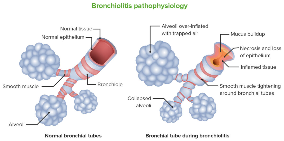 Bronchiolitis pathophysiology
