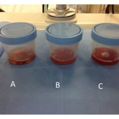 Bronchoalveolar fluid samples become progressively more hemorrhagic in diffuse alveolar hemorrhage