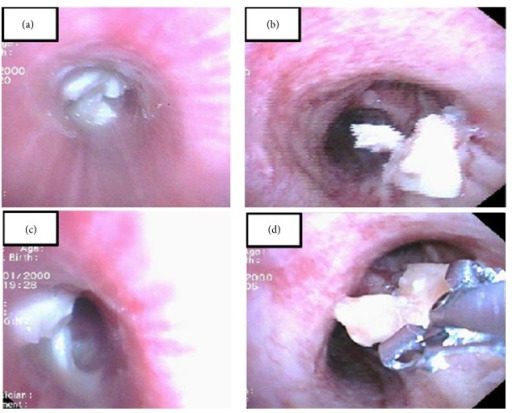 Bronchoscopy can be used for the diagnosis and retrieval of foreign bodies
