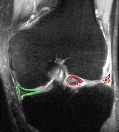 Bucket-handle tear of the lateral meniscus mri