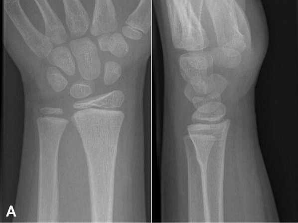 Buckle fracture, rated as buckle on all readings