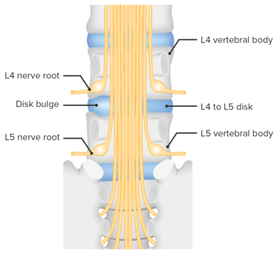 Spinal Disk Herniation | Concise Medical Knowledge