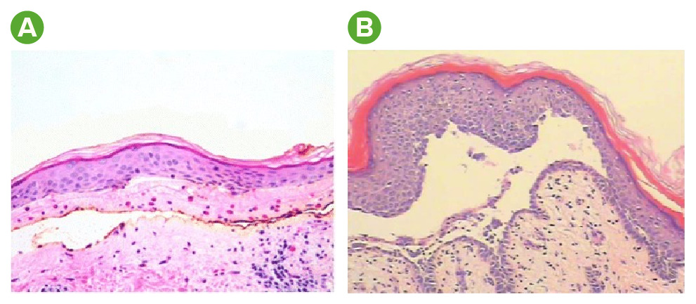 pemphigoid histology