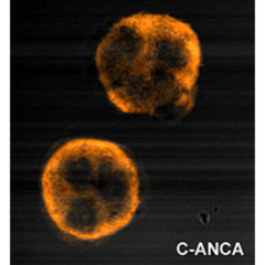 C-ANCA Granulomatosis
