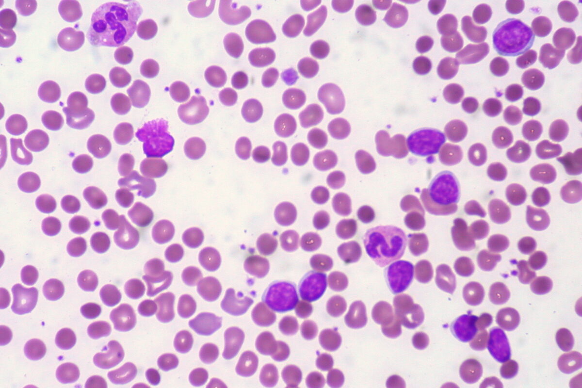 Cll with autoimmune hemolytic anemia