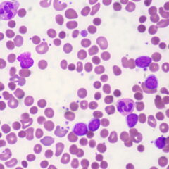 CLL with autoimmune hemolytic anemia
