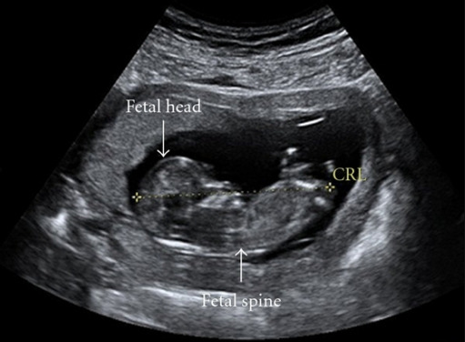 Restricci n Del Crecimiento Fetal Concise Medical Knowledge Restricci n Del Crecimiento Fetal Concise Medical Knowledge