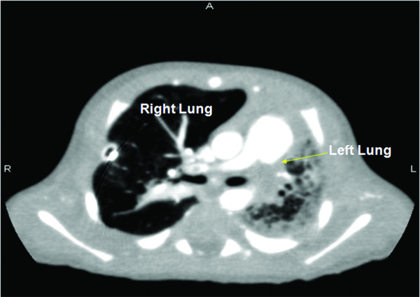 Hipoplasia pulmonar em tc