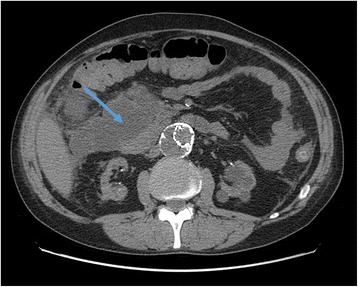 Ct scan acute pancreatitis patchy necrosis