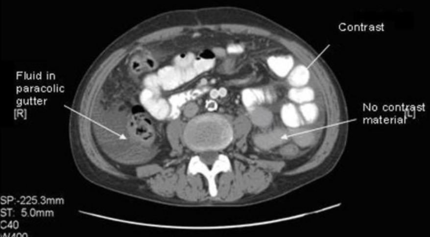 Ct abdomen with and without contrast showing differential contrast distribution