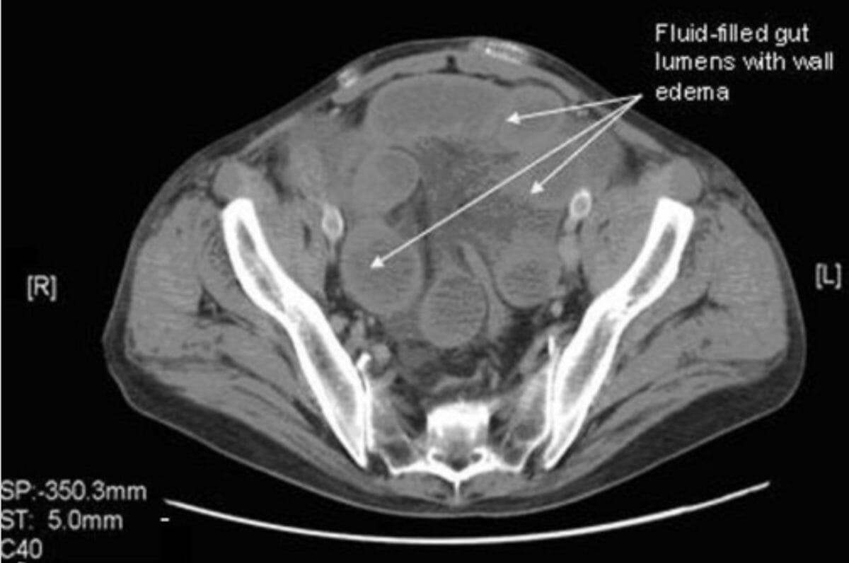 Tc de abdome com e sem contraste mostrando lúmens intestinais cheios de líquido com edema de parede