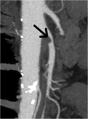 Angiograma por tomografía computarizada que muestra estenosis de la arteria mesentérica superior