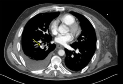 Pulmonary Embolism | Concise Medical Knowledge