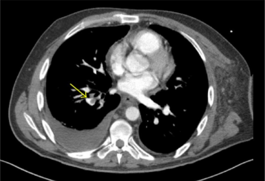 Ct angiography demonstrating lobar and segmental pulmonary emboli