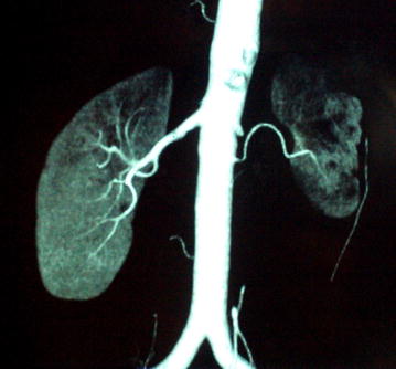 Ct angiography left renal artery obstruction